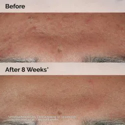 سرم ضد جوش Niacinamide 10% + Zinc 1% اوردینری حجم 60 میلی لیتر