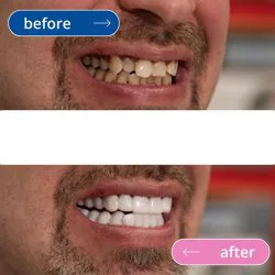 لمینت دندان دو فک مدل TruSmile (اورجینال)